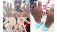 আর্সেনিক আক্রান্ত বালিয়াডাঙ্গা ইউনিয়নের বেতবাড়িয়া গ্রামের  অধিকাংশ মানুষ 