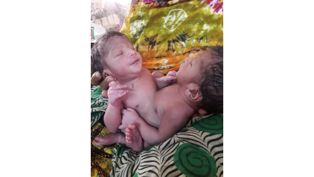 চাঁপাইনবাবগঞ্জে শরীর জোড়া লাগানো যমজ সন্তানের জন্ম - বিপাকে গরীব পরিবার 