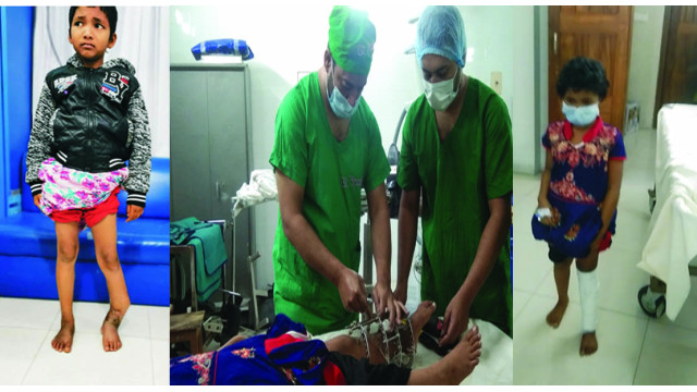 চাঁপাইনবাবগঞ্জে সুখীমনের ৭ বছরের  বাঁকা পা  সোজা করলেন ডা. ইসমাইল 